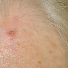 Keratose actinique 3