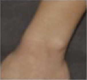 Application de la crème barrière : J22