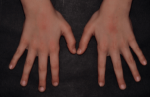 Application de la crème barrière : J1