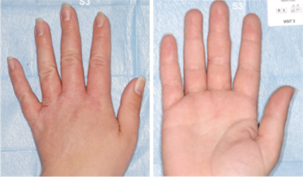 Application de Dexyane MeD crème : Jour 22