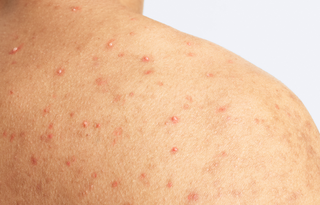 du_keracnyl_body spray_men_pathology_4x5_01.2026