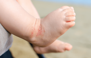 Comment prendre soin de la peau atopique de mon enfant ?