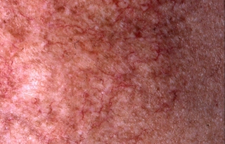 Visuel radiodermite