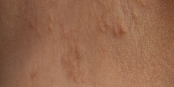 Dermatose polymorphe