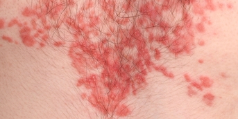 Rash