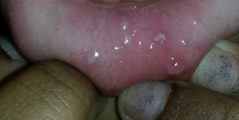 BlisterRed