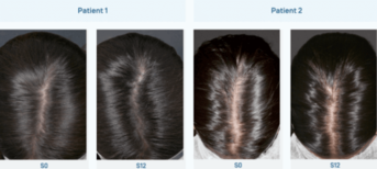 anaphase shampoo