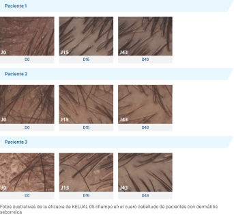 ES-Kelual DS Shampooing · Photos illustratives.png