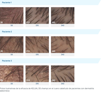 ES-Kelual DS Shampooing · Photos illustratives.png