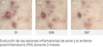 ES-Keracnyl Serum - Evolution lésions.png