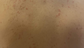 Dermatose inflammtoire du tronc ketorash 2