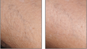 ES-Sensinol Lait · Illustration Xerose.png