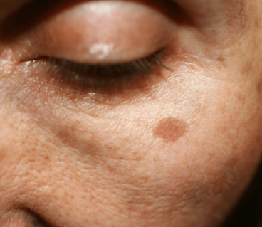 du_article_brown-spots_body2